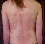 affections:peau:psoriasis_on_back1.jpg